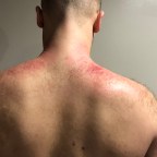 Why Instrument Assisted Soft Tissue Mobilization?  (IASTM)